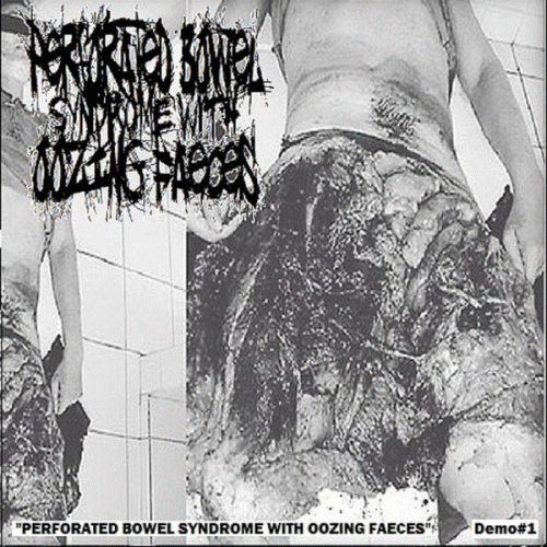 Perforated Bowel Syndrome With Oozing Faeces : Perforated Bowel Syndrome with Oozing Faeces